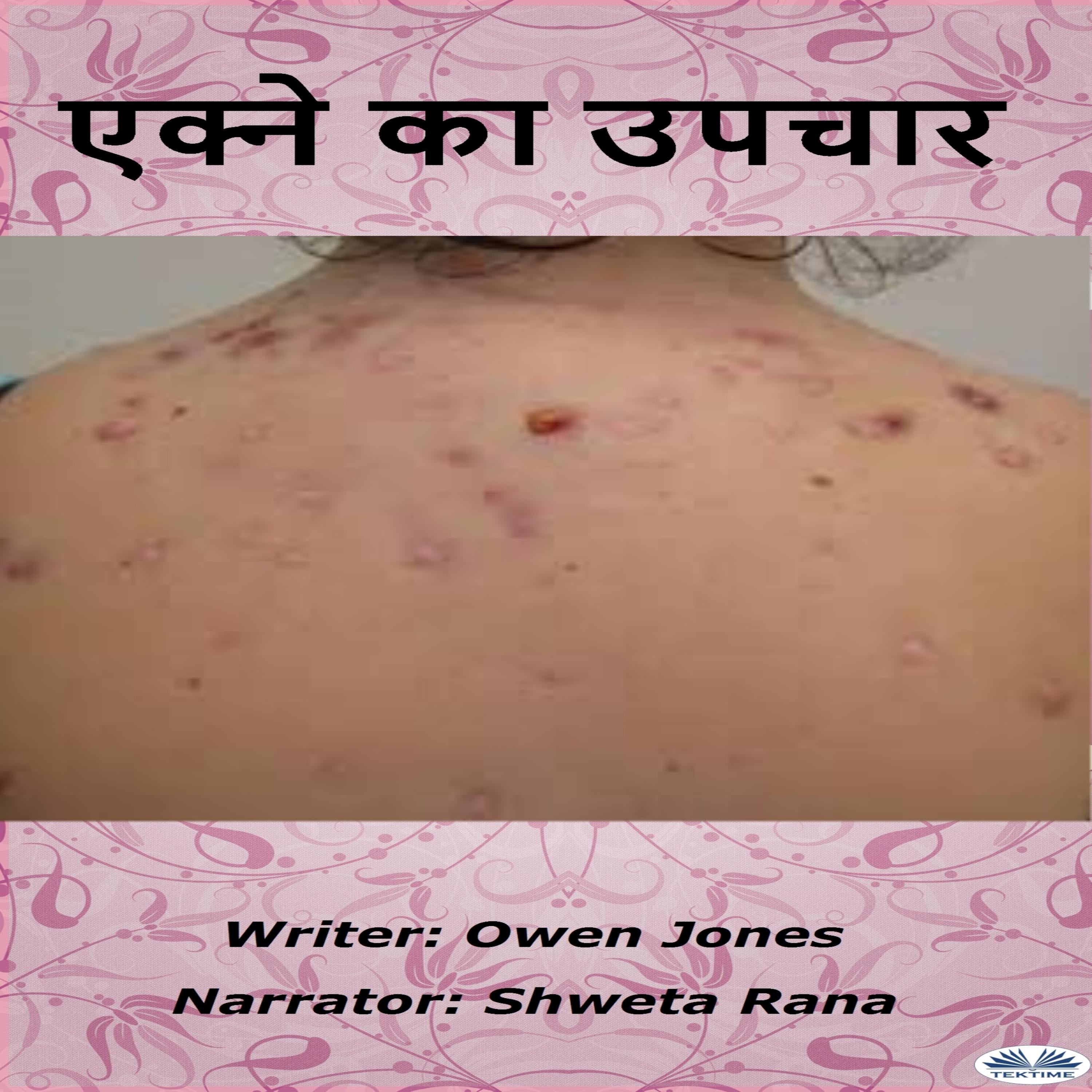 एक्ने का उपचार