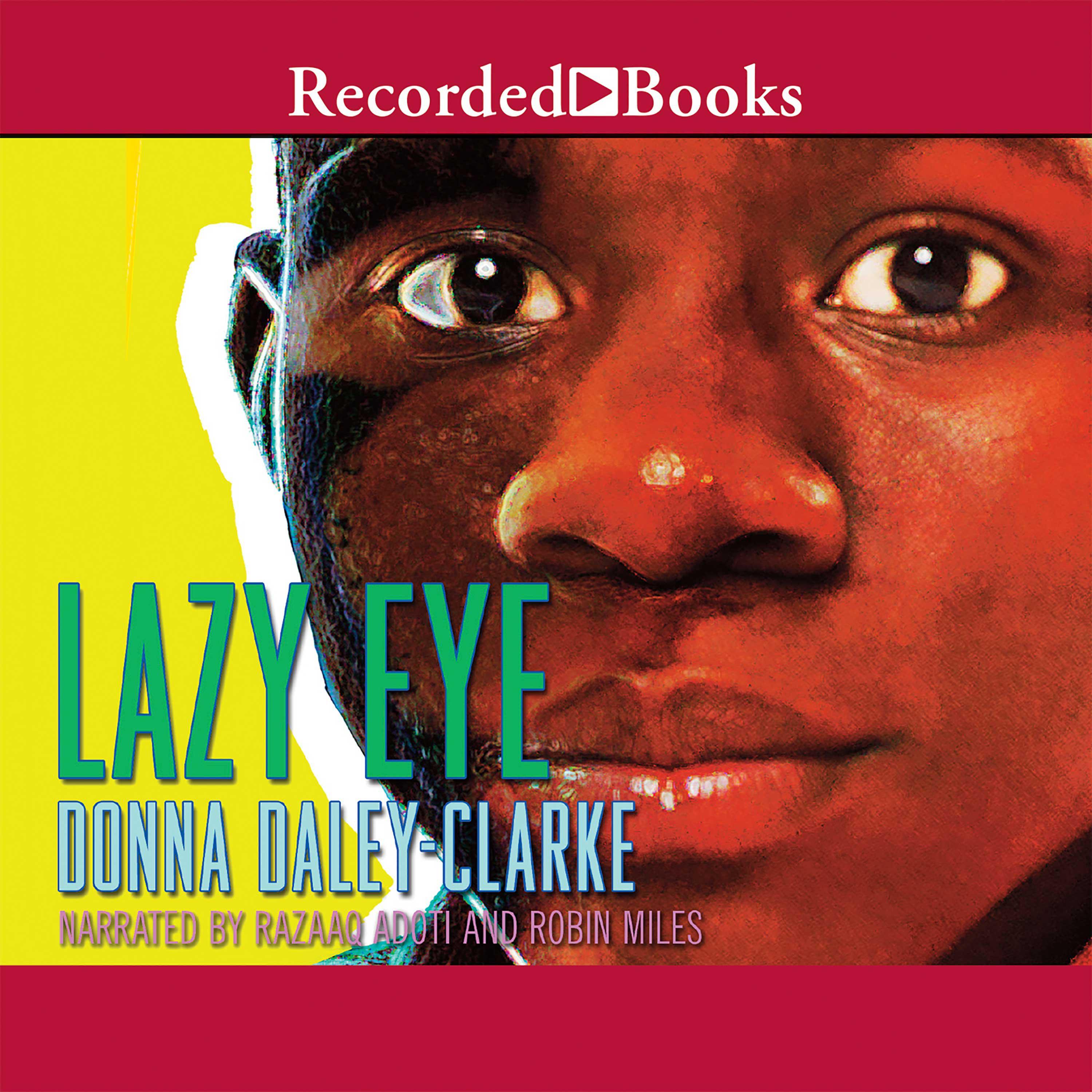 Lazy Eye